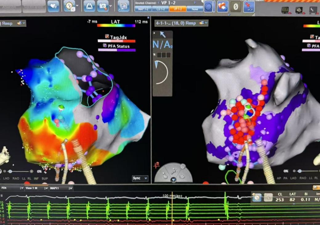 双形双能消融房扑转为窦性心律