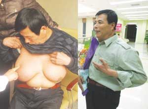 山东汉烦恼长大乳房:别叫我假女人我是纯爷们--